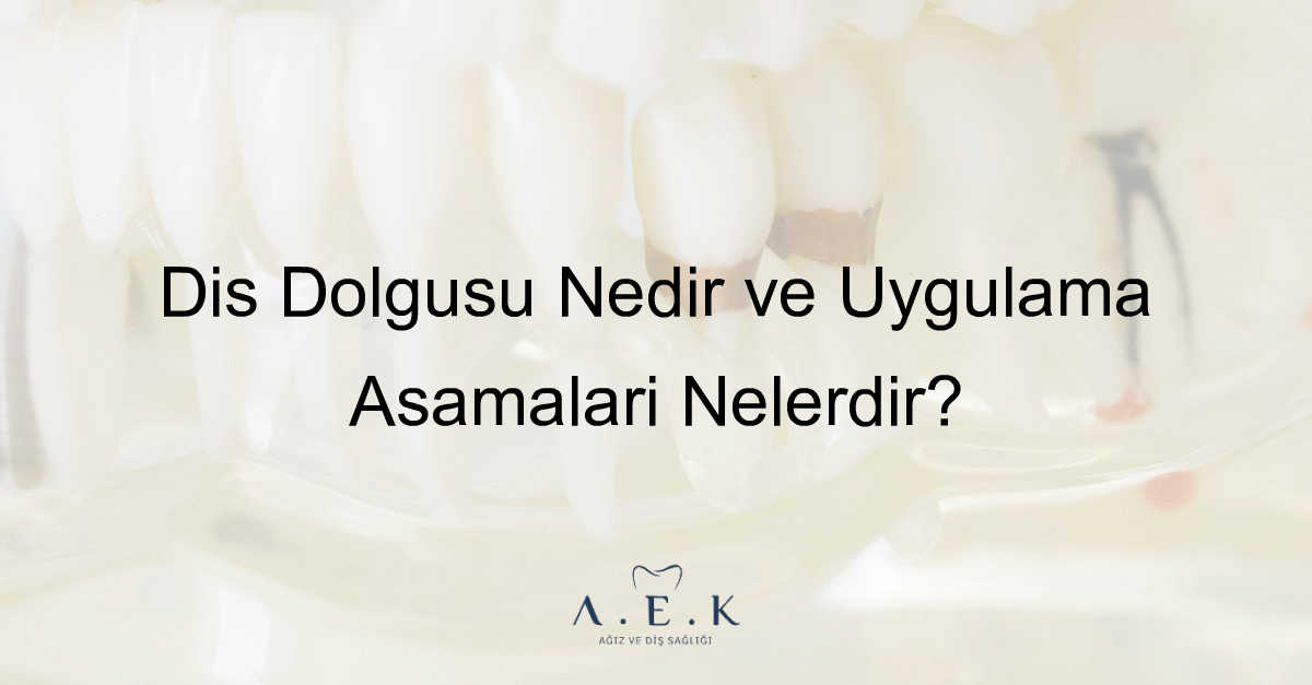 Diş Dolgusu Nedir Dolgu Nasil Yapilir - AEK Dent